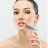 Prevention and treatment of acne